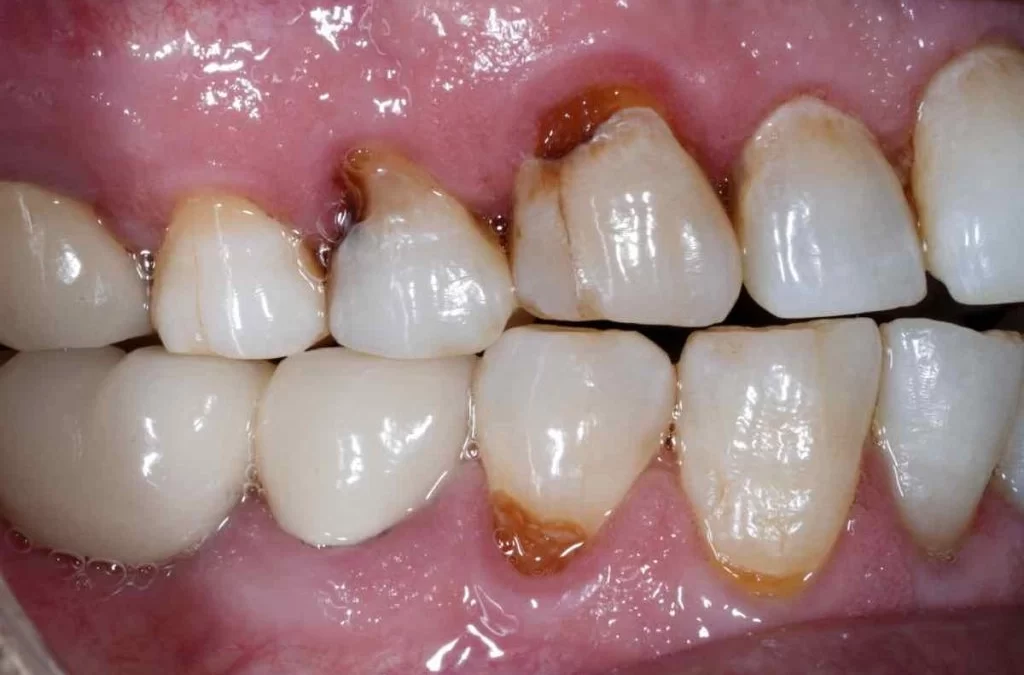 Etapas de una caries dental, causa raíz, soluciones y gestión de riesgos
