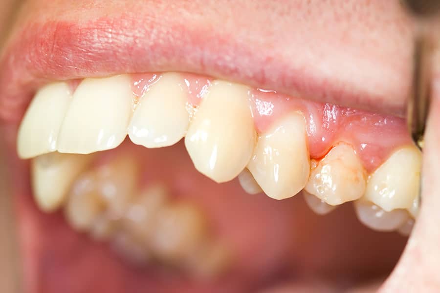  The connection between plaque and gingivitis
