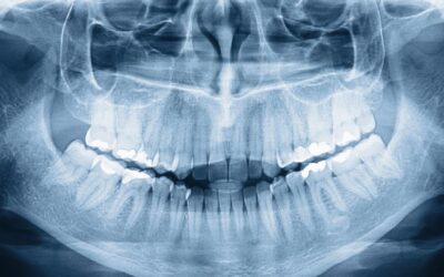 What do we see in dental radiographs?